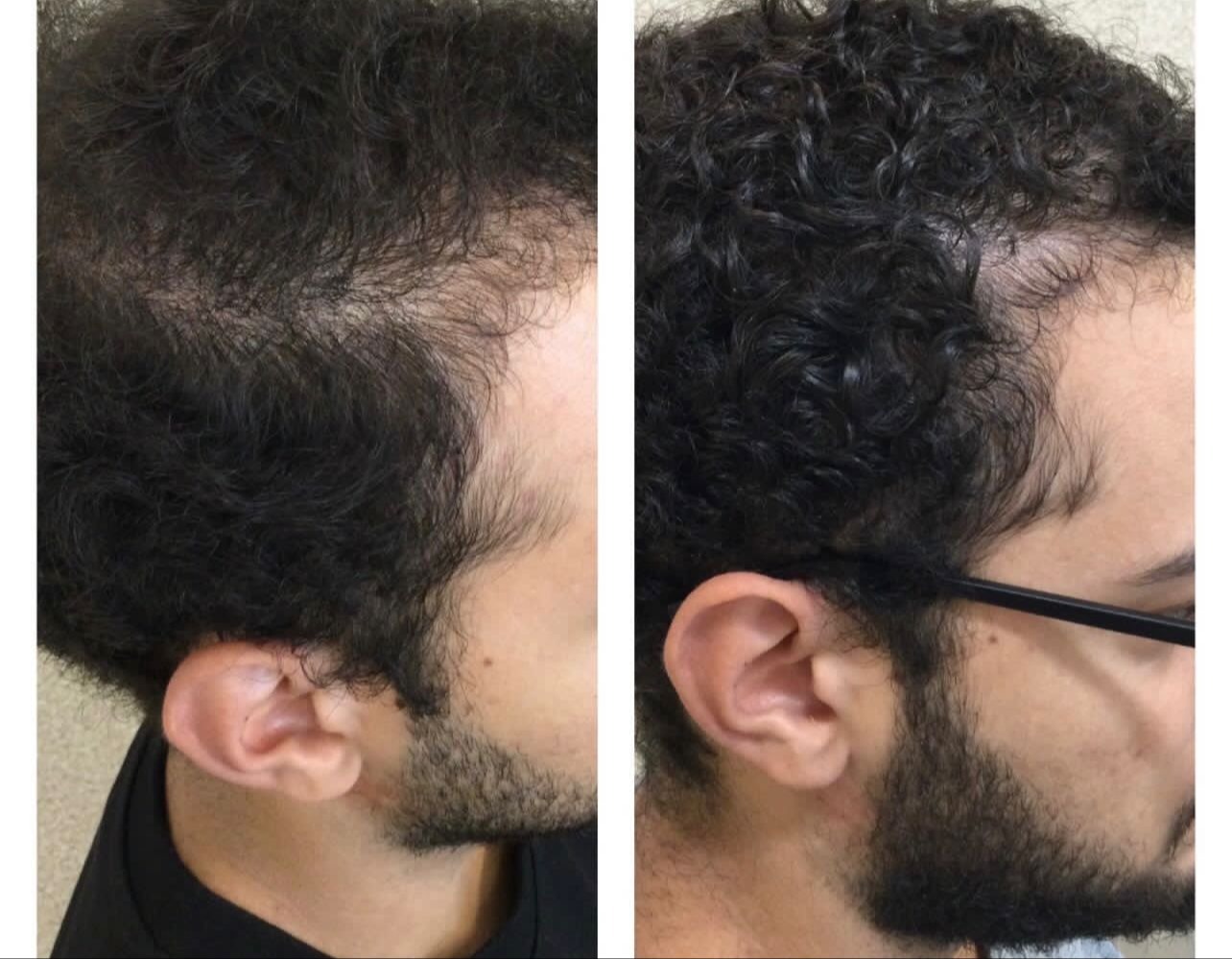 Resultado Hair Growth LC