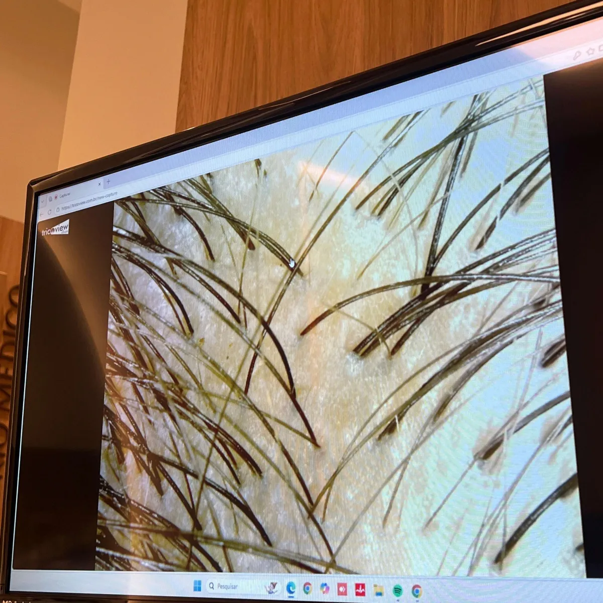 Dra. Louise com Tricoscopia Digital